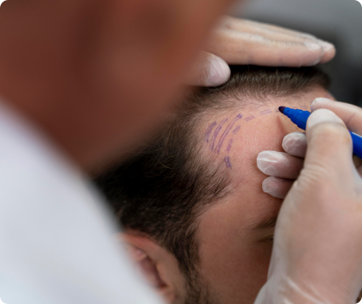 Hair Transplant Surgery